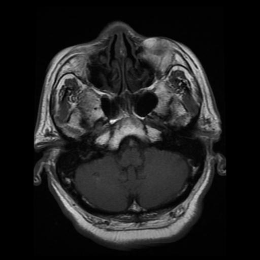 Acute vertebrobasilar ischemic infarction | Image | Radiopaedia.org