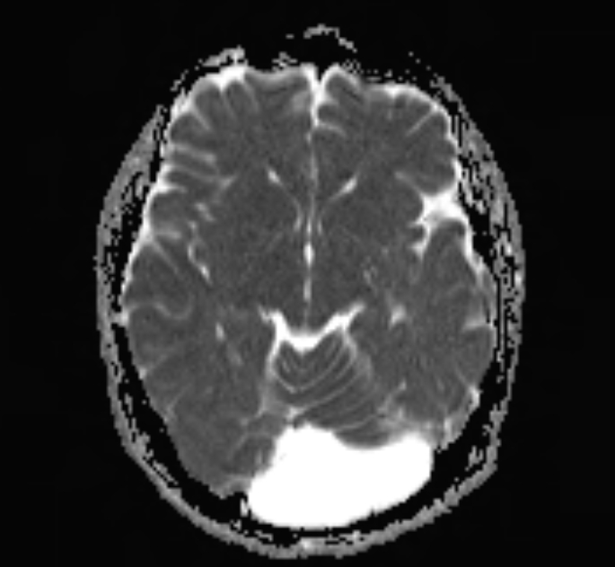 Retrocerebellar Arachnoid Cyst Image