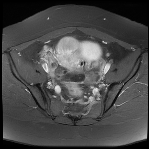 Uterine Leiomyomas And Bilateral Ovarian Fibromas | Image | Radiopaedia.org