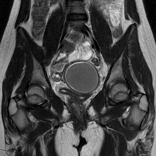 Hematometrocolpos - lower vaginal atresia | Image | Radiopaedia.org