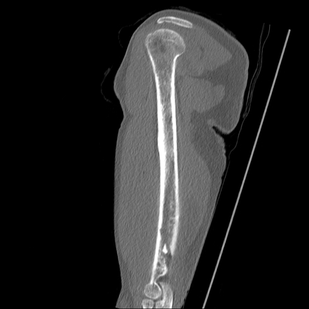 Osteomyelitis X Rays