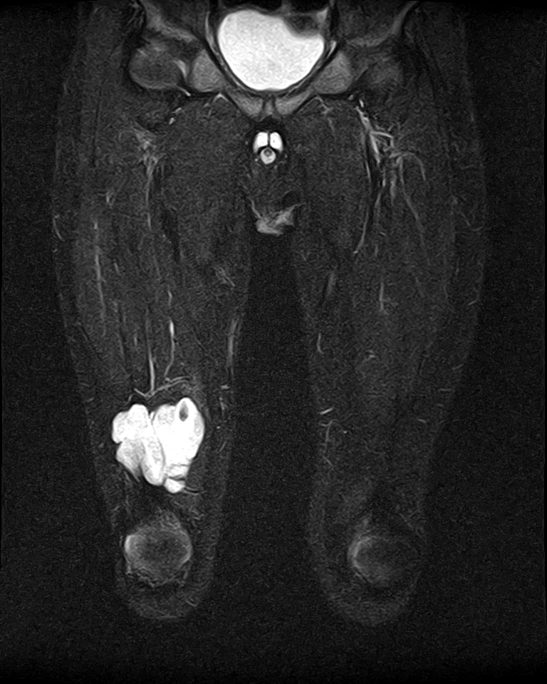 Intramuscular hemangioma Image