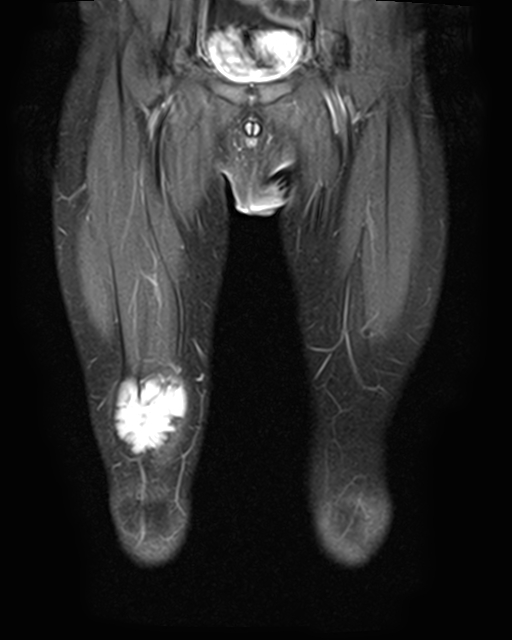 Intramuscular Hemangioma Image Radiopaedia Org