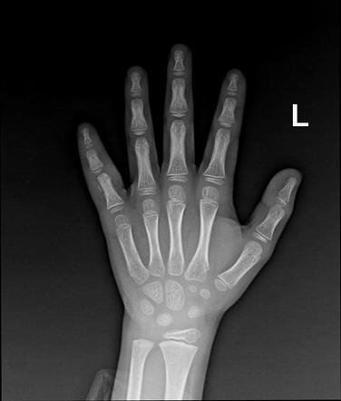 Fifth finger fracture - proximal phalanx | Radiology Case | Radiopaedia.org