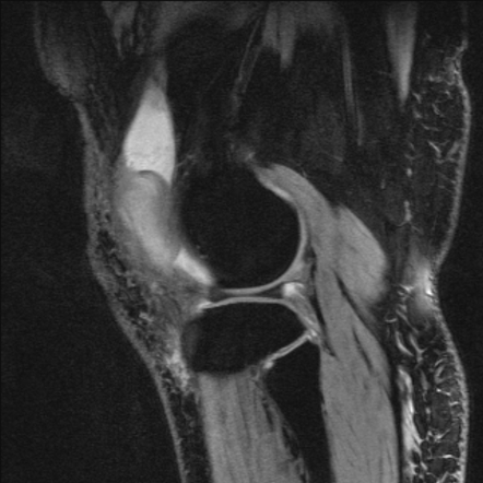 Bilateral focal pigmented villonodular synovitis | Image | Radiopaedia.org