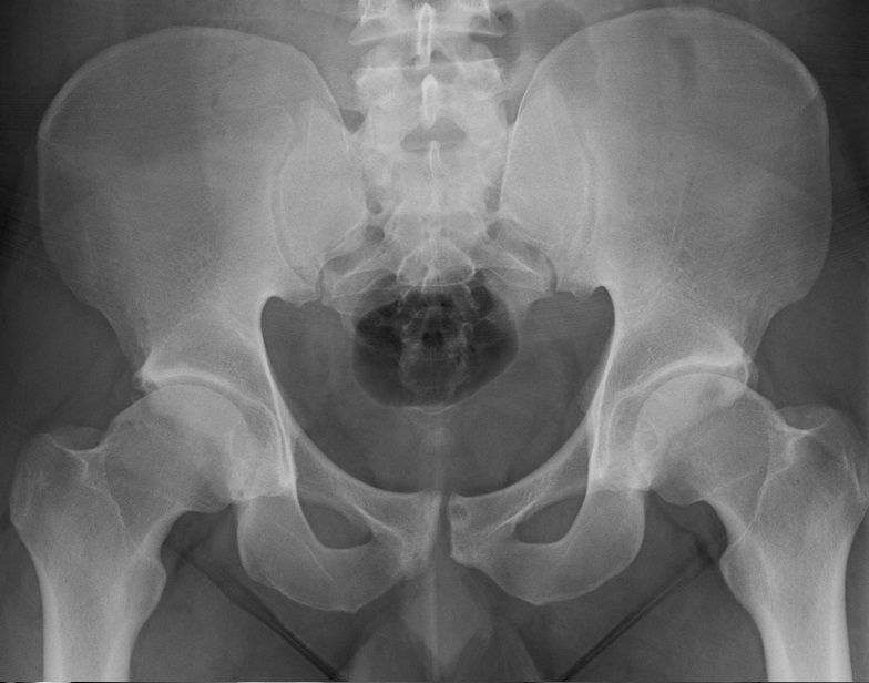 Femoroacetabular impingement - mixed-type | Image | Radiopaedia.org