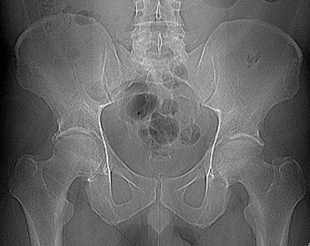 Femoroacetabular Impingement - Pincer Type | Radiology Case ...