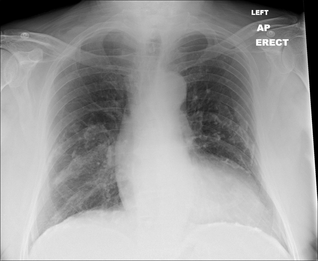 Calcified Pleural Plaques Radiology Case Radiopaedia Org