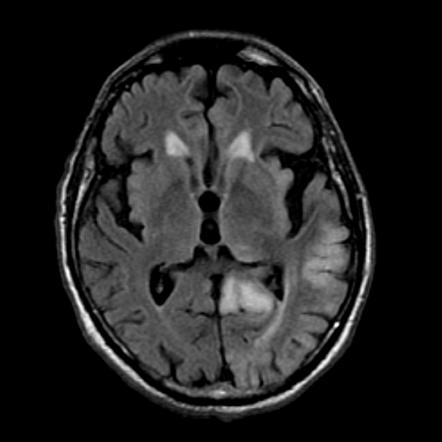 Postictal cortical restricted diffusion and edema | Image | Radiopaedia.org