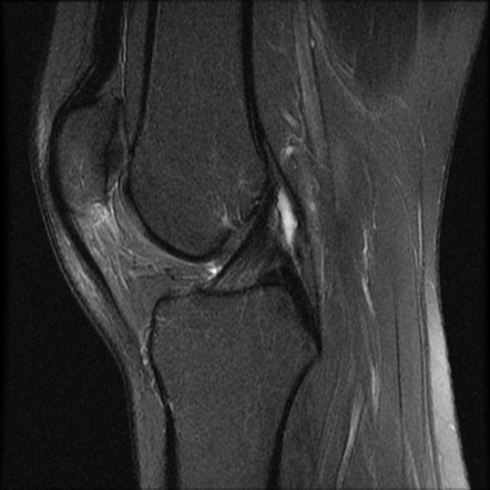 Transient lateral patellar dislocation | Image | Radiopaedia.org