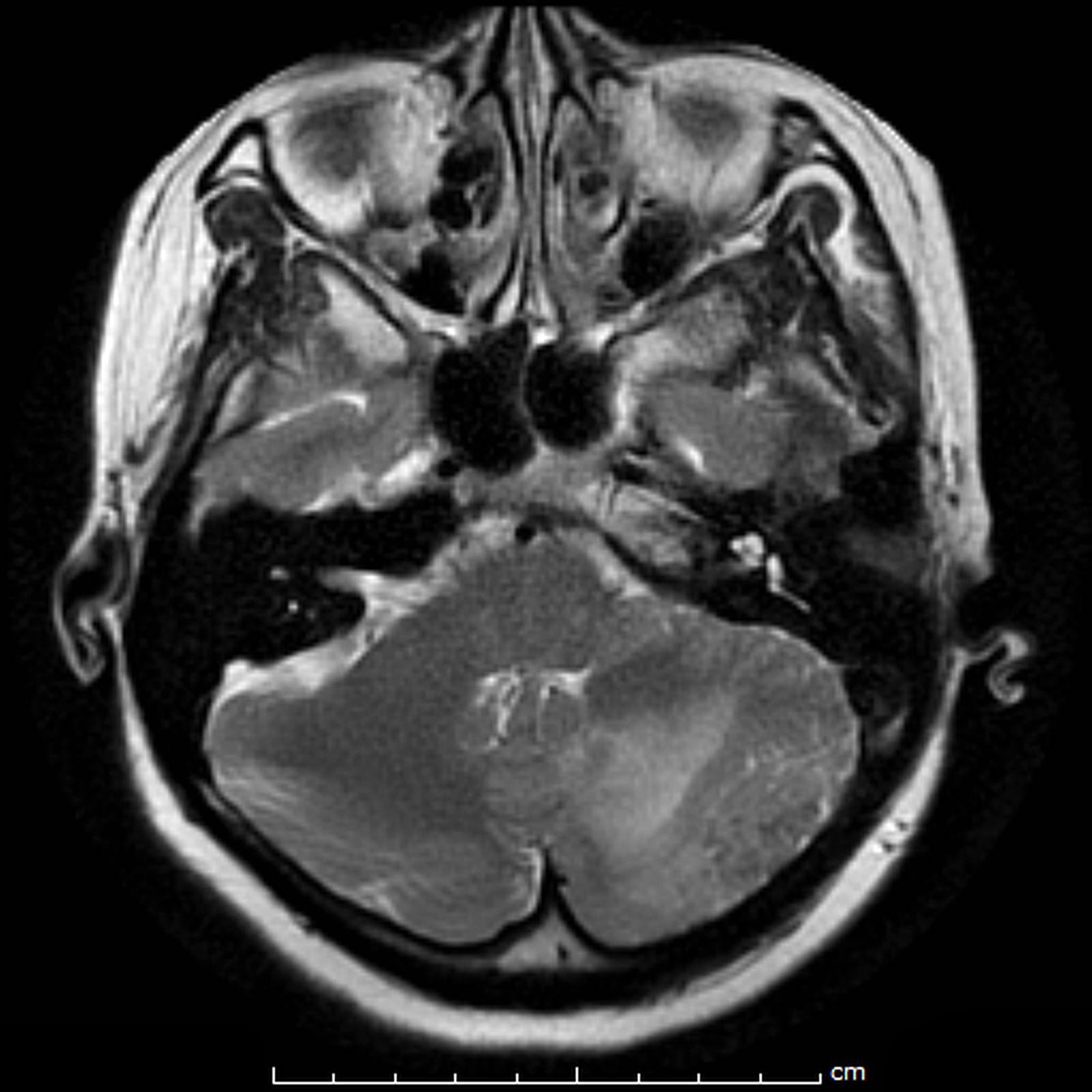 Dural Metastasis | Image | Radiopaedia.org