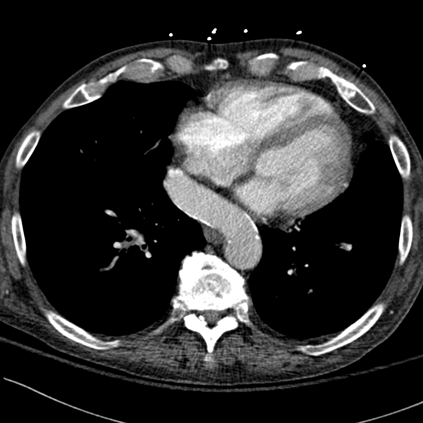 Extra-anatomic ascending-to-descending aortic bypass for aortic ...