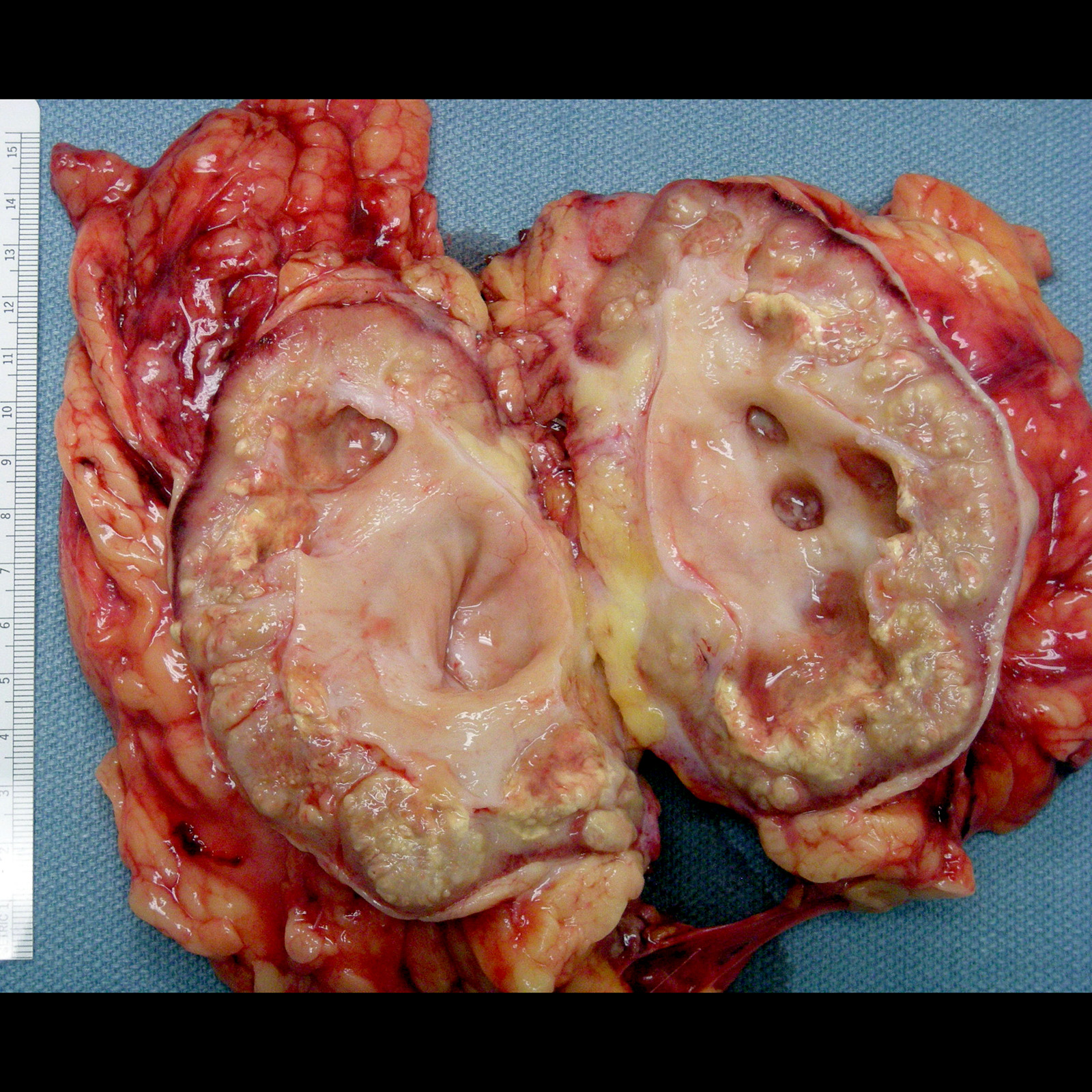 Xanthogranulomatous pyelonephritis (gross pathology) | Image