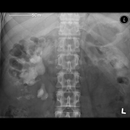 Xanthogranulomatous pyelonephritis | Radiology Reference Article ...