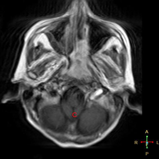 Nasopharyngeal carcinoma infiltrating the clivus | Image | Radiopaedia.org