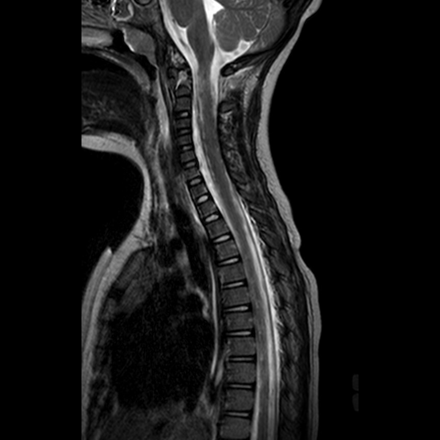 Craniocervical junction injury | Image | Radiopaedia.org