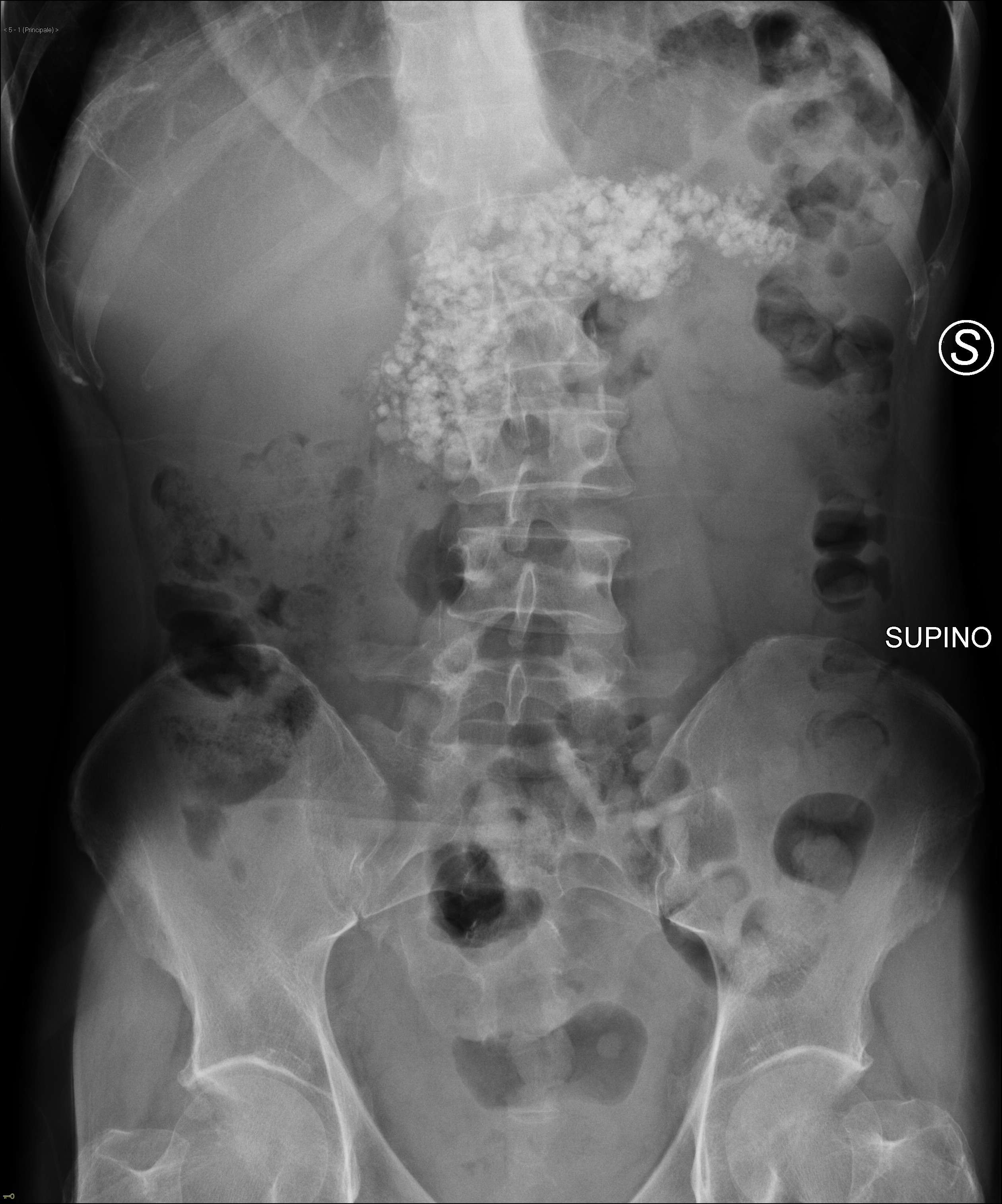 Pancreatic Calcifications Chronic Pancreatitis Image