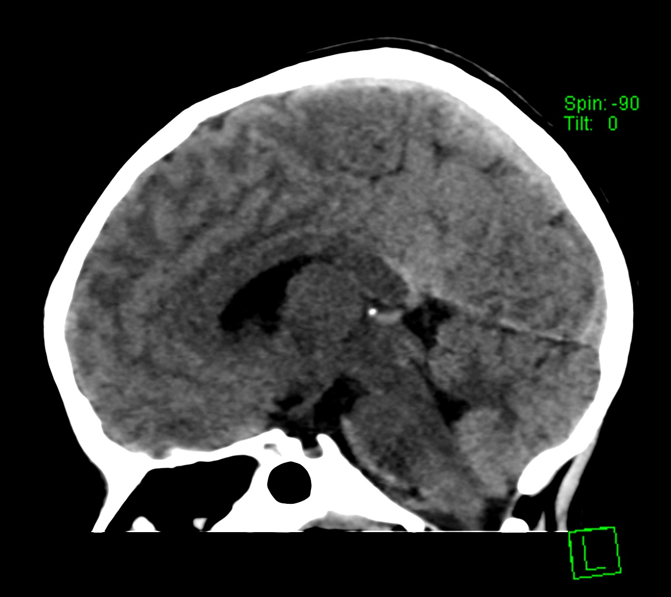 Maple syrup urine disease Image