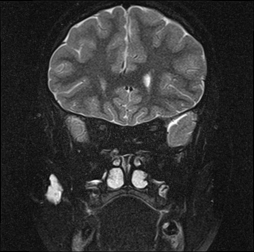 Intramuscular hemangioma masseter muscle Image