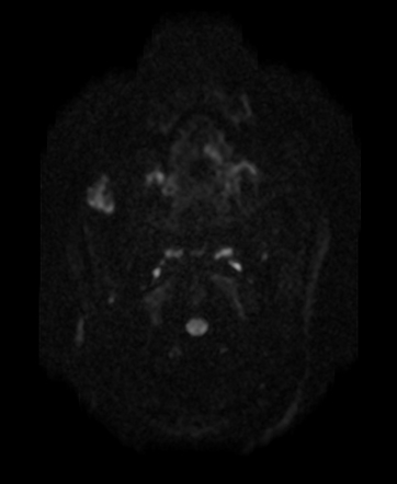 Intramuscular hemangioma - masseter muscle | Image | Radiopaedia.org