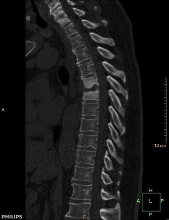 Spondylodiscitis | Radiology Case | Radiopaedia.org