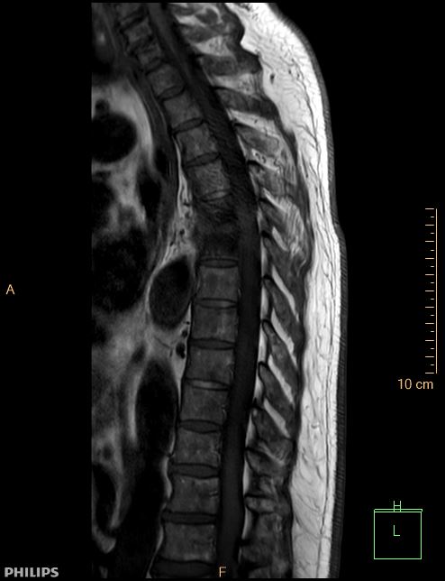 Spondylodiscitis | Image | Radiopaedia.org