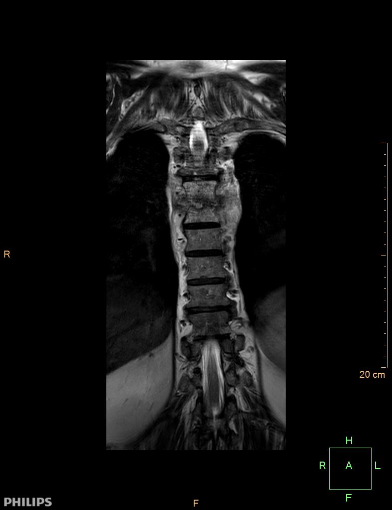 Spondylodiscitis | Image | Radiopaedia.org