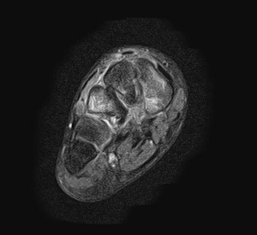 Widespread bony edema after foot injury | Image | Radiopaedia.org