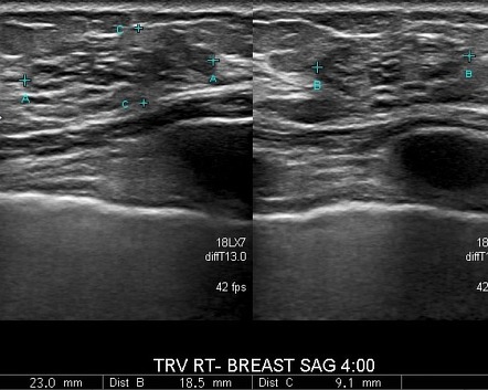 Viewing playlist: Breast Mass | Radiopaedia.org