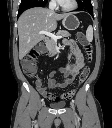 How to read a CT of the abdomen and pelvis | Image | Radiopaedia.org