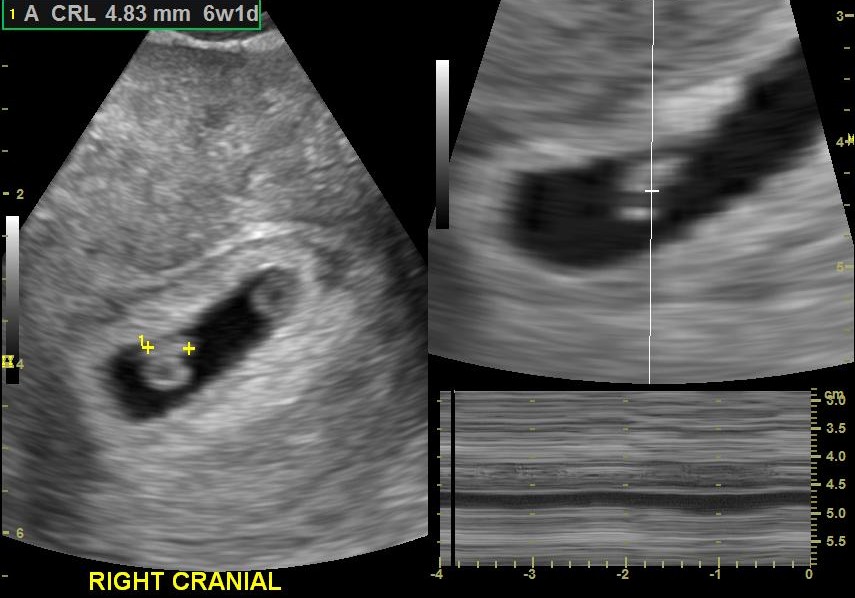 Dichorionic Tri Amniotic Dcta Triplets Image 