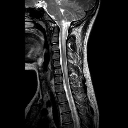 Von Hippel-Lindau disease | Image | Radiopaedia.org