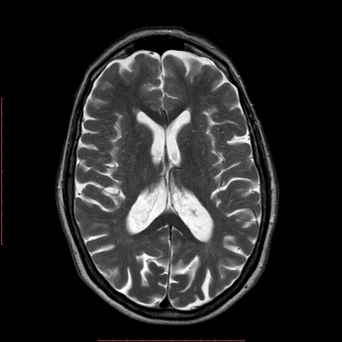 Choroid plexus xanthogranuloma | Image | Radiopaedia.org