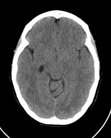 Choroidal fissure cyst | Radiology Case | Radiopaedia.org