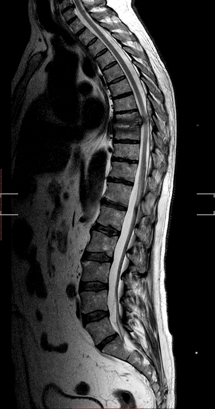 Spondylodiskitis | Image | Radiopaedia.org