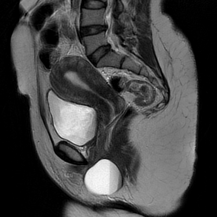 Bartholin gland cyst Radiology Case Radiopaedia.org.