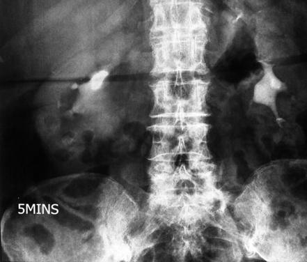 Pelvi-ureteric junction obstruction | Radiology Case | Radiopaedia.org