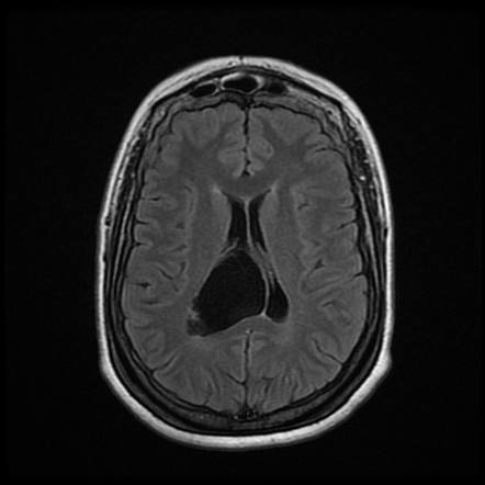 Intraventricular arachnoid cyst | Radiology Case | Radiopaedia.org