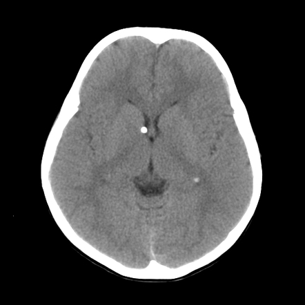 Tuberous sclerosis | Radiology Case | Radiopaedia.org