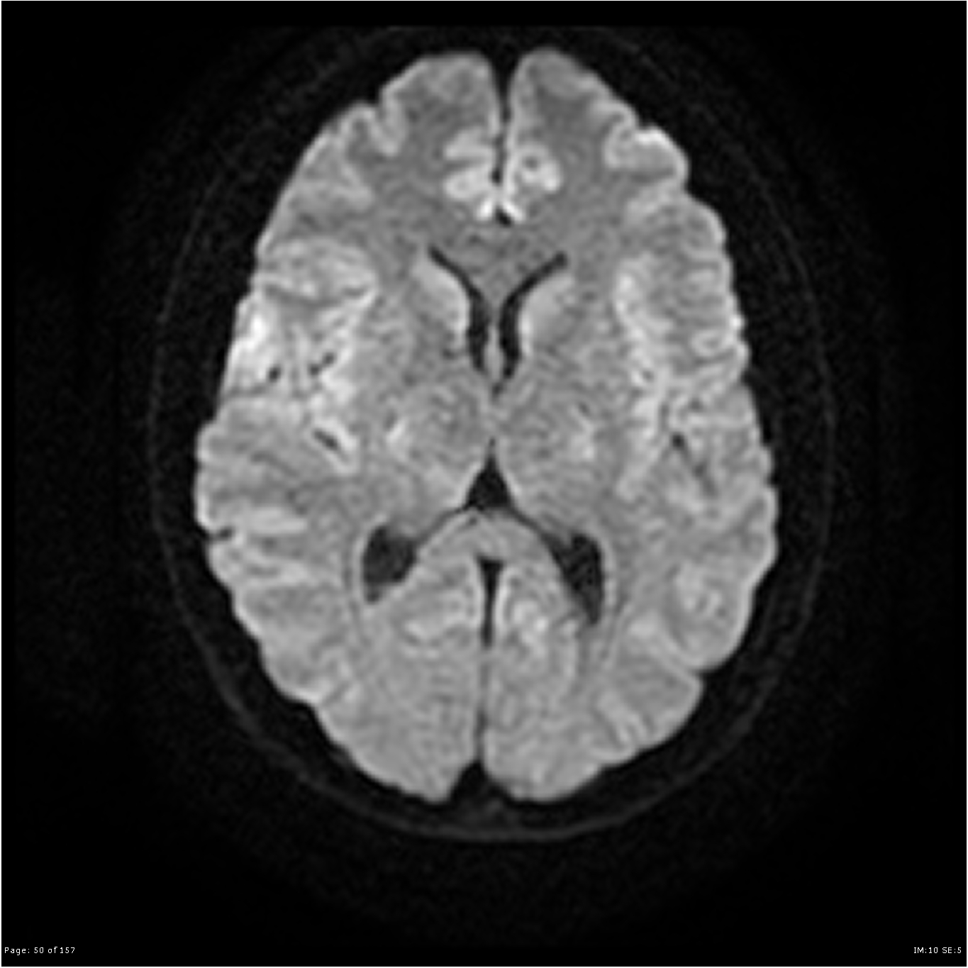 Chordoid meningioma | Image | Radiopaedia.org