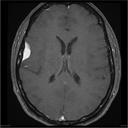 Chordoid meningioma | Radiology Case | Radiopaedia.org