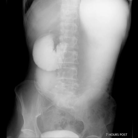 SMA syndrome | Radiology Case | Radiopaedia.org