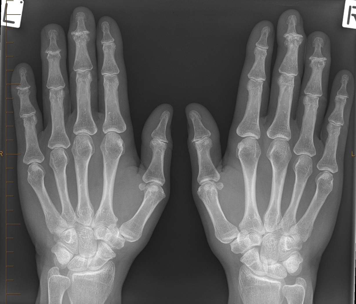 Distal Interphalangeal Joint Range Of Motion at Fernando Daugherty blog