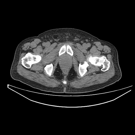 Fournier gangrene | Radiology Case | Radiopaedia.org