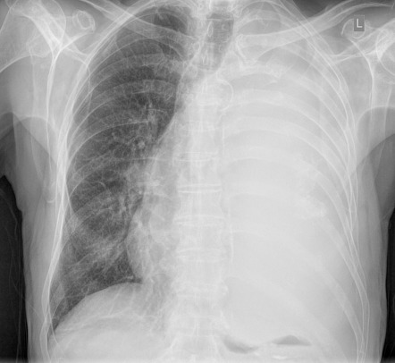 Hemithorax white-out - pleural effusion | Radiology Case | Radiopaedia.org