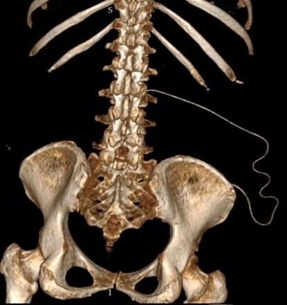 Lumboperitoneal shunt | Image | Radiopaedia.org