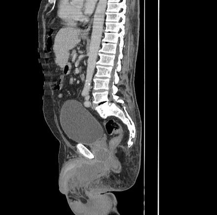 Fournier gangrene | Image | Radiopaedia.org