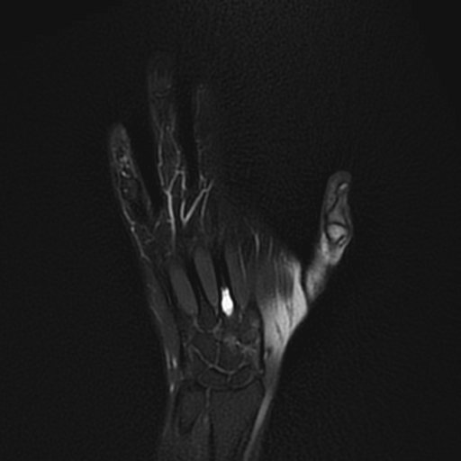 Enchondroma - metacarpal bone | Image | Radiopaedia.org