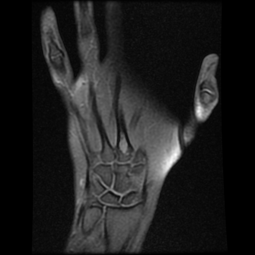 Enchondroma - metacarpal bone | Image | Radiopaedia.org