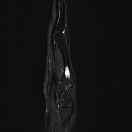 Enchondroma - metacarpal bone | Radiology Case | Radiopaedia.org